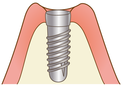 一次手術（インプラント埋入）
