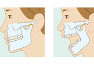顎関節症