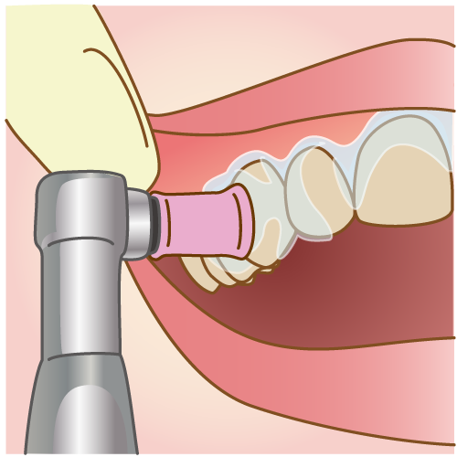 歯のクリーニング・前処置